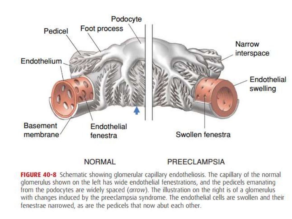 Prognosis and complications of eclampsia