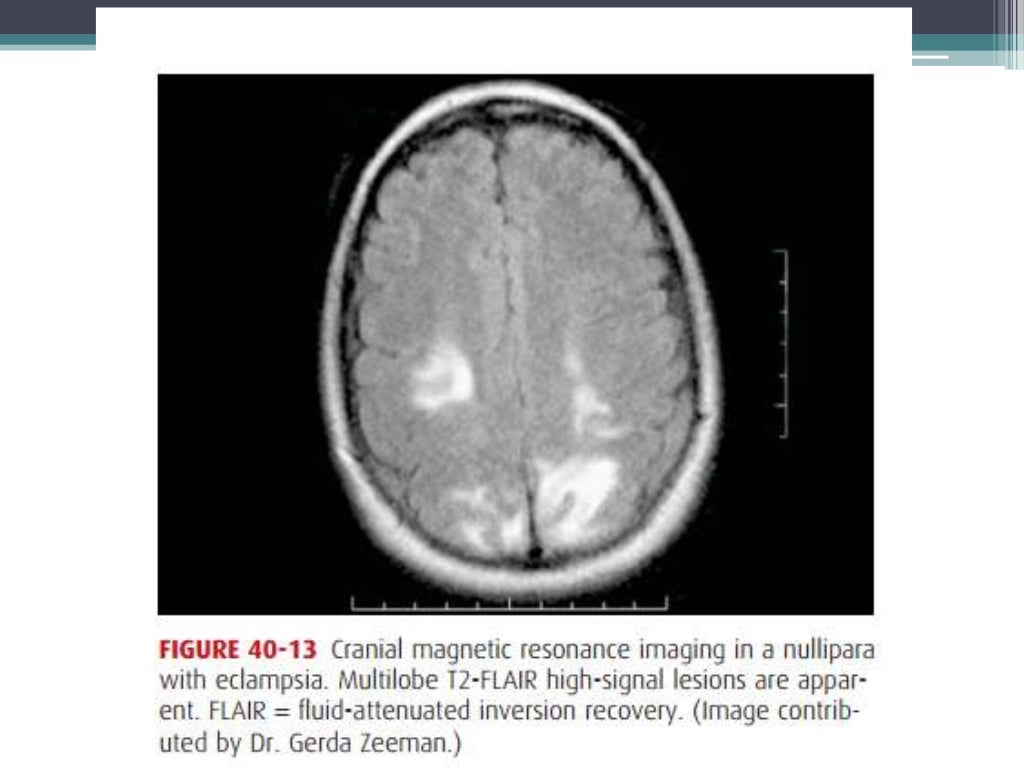 Prognosis and complications of eclampsia