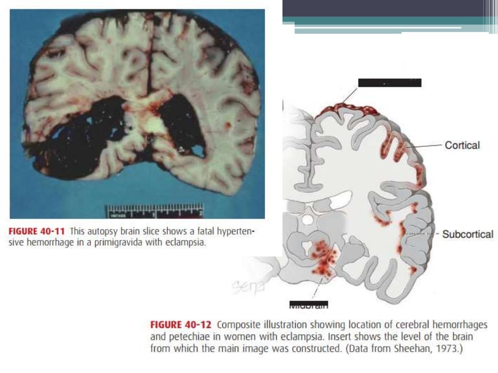 Prognosis and complications of eclampsia