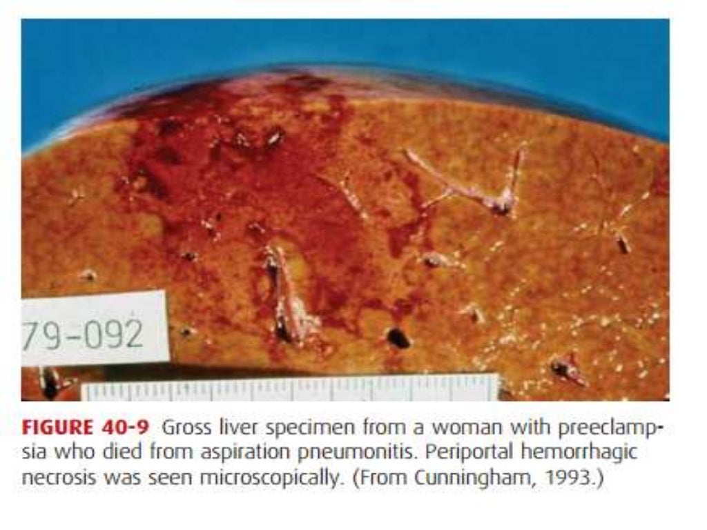Prognosis and complications of eclampsia