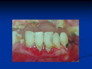  O que influi nas condições que podem aumentar ou diminuir sua expressão?Idade, raça, gênero, fatores sócio-econômicos, conhecimento, estresse, saliva, dieta, tipo debactérias, última visita ao dentista, fatores emocionais, fumo, doenças sistêmicas, higiene bucal, quantidade de doença prévia… GDC, 2008