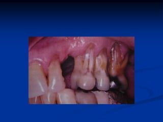 BASES BIOLÓGICAS DO DIAGNÓSTICOCÁRIEEstudo de Vipeholm (1956)DOENÇA PERIODONTAL Estudo de gengivite experimental em humanos (Loe et al., 1965).Estudo de periodontite induzida em cães (Lindhe et al., 1975).Estudo dos plantadores de chá do Sri Lanka (Loe et al., 1986).