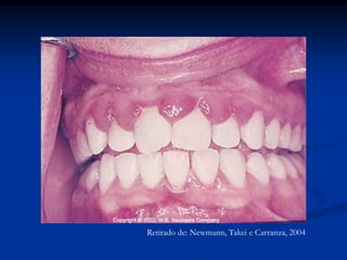 A resposta ao tratamento será adequada caso o diagnóstico tenha sido correto. O tratamento visa eliminar ou reduzir o agente etiológicoCaso não responda ao tratamento devo questionar o diagnóstico inicialO problema está quando o prognóstico da enfermidade é grave para a saúde do paciente!!!!!CONSIDERAÇÕESGDC, 2008