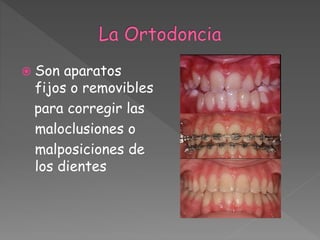  Son aparatos
fijos o removibles
para corregir las
maloclusiones o
malposiciones de
los dientes
 