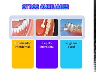 Estimulador
interdental.
Cepillo
interdental
Irrigador
bucal
 