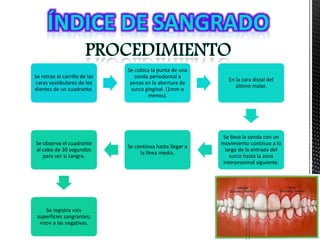 Se retrae el carrillo de las
caras vestibulares de los
dientes de un cuadrante.
Se coloca la punta de una
sonda periodontal a
penas en la abertura de
surco gingival. (1mm o
menos).
En la cara distal del
último molar.
Se lleva la sonda con un
movimiento continuo a lo
largo de la entrada del
surco hasta la zona
interproximal siguiente.
Se continua hasta llegar a
la línea media.
Se observa el cuadrante
al cabo de 30 segundos
para ver si sangra.
Se registra «sí»
superficies sangrantes;
«no» a las negativas.
 