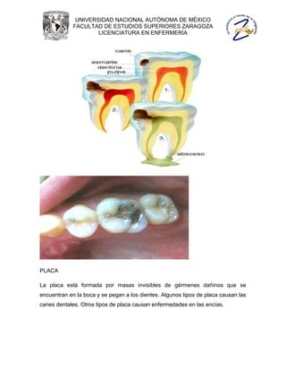 UNIVERSIDAD NACIONAL AUTÓNOMA DE MÉXICO
             FACULTAD DE ESTUDIOS SUPERIORES ZARAGOZA
                     LICENCIATURA EN ENFERMERÍA




PLACA

La placa está formada por masas invisibles de gérmenes dañinos que se
encuentran en la boca y se pegan a los dientes. Algunos tipos de placa causan las
caries dentales. Otros tipos de placa causan enfermedades en las encías.
 