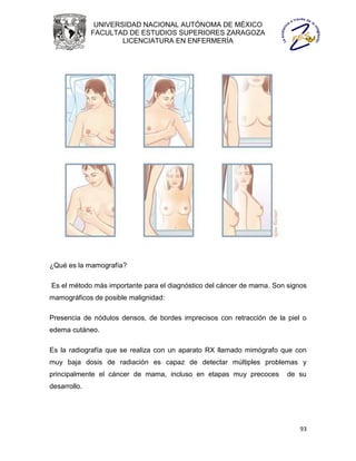 UNIVERSIDAD NACIONAL AUTÓNOMA DE MÉXICO
              FACULTAD DE ESTUDIOS SUPERIORES ZARAGOZA
                      LICENCIATURA EN ENFERMERÍA




¿Qué es la mamografía?

Es el método más importante para el diagnóstico del cáncer de mama. Son signos
mamográficos de posible malignidad:

Presencia de nódulos densos, de bordes imprecisos con retracción de la piel o
edema cutáneo.

Es la radiografía que se realiza con un aparato RX llamado mimógrafo que con
muy baja dosis de radiación es capaz de detectar múltiples problemas y
principalmente el cáncer de mama, incluso en etapas muy precoces        de su
desarrollo.




                                                                            93
 