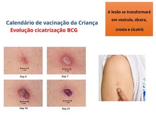 Calendário de vacinação da Criança
Evolução cicatrização BCG
A lesão se transformará
em vesícula, úlcera,
crosta e cicatriz
 