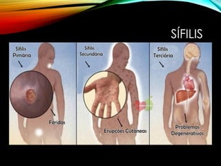 SÍFILIS
 