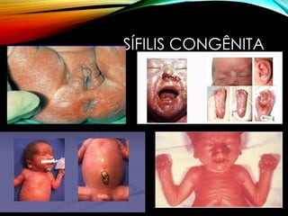 SÍFILIS CONGÊNITA
 