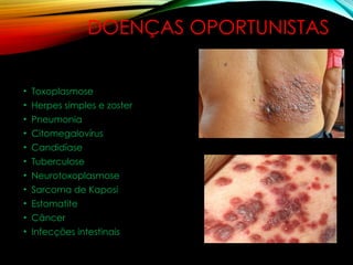 DOENÇAS OPORTUNISTAS
• Toxoplasmose
• Herpes simples e zoster
• Pneumonia
• Citomegalovírus
• Candidíase
• Tuberculose
• Neurotoxoplasmose
• Sarcoma de Kaposi
• Estomatite
• Câncer
• Infecções intestinais
 
