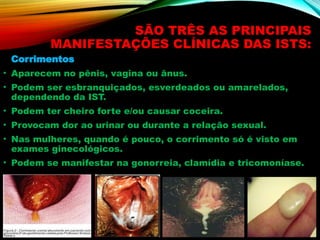SÃO TRÊS AS PRINCIPAIS
MANIFESTAÇÕES CLÍNICAS DAS ISTS:
Corrimentos
• Aparecem no pênis, vagina ou ânus.
• Podem ser esbranquiçados, esverdeados ou amarelados,
dependendo da IST.
• Podem ter cheiro forte e/ou causar coceira.
• Provocam dor ao urinar ou durante a relação sexual.
• Nas mulheres, quando é pouco, o corrimento só é visto em
exames ginecológicos.
• Podem se manifestar na gonorreia, clamídia e tricomoníase.
 