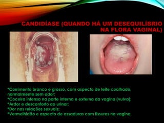CANDIDÍASE (QUANDO HÁ UM DESEQUILÍBRIO
NA FLORA VAGINAL)
*Corrimento branco e grosso, com aspecto de leite coalhado,
normalmente sem odor;
*Coceira intensa na parte interna e externa da vagina (vulva);
*Ardor e desconforto ao urinar;
*Dor nas relações sexuais;
*Vermelhidão e aspecto de assaduras com fissuras na vagina.
 