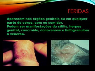 FERIDAS
Aparecem nos órgãos genitais ou em qualquer
parte do corpo, com ou sem dor.
Podem ser manifestações da sífilis, herpes
genital, cancroide, donovanose e linfogranulom
a venéreo.
 