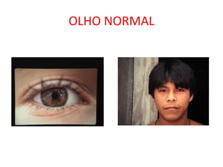 OLHO NORMAL
 