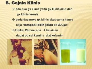 B. Gejala Klinis
    ada dua gx klinis yaitu gx klinis akut dan
      gx klinis kronis
    pada dasarnya gx klinis akut sama hanya
     saja tampak lebih jelas pd Brugia.
   Infeksi Wuchereria  kelainan
     dapat pd sal kemih / alat kelamin.
 