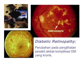 Diabetic Retinopathy;
Perubahan pada penglihatan
pesakit akibat komplikasi DM
yang kronik.
 
