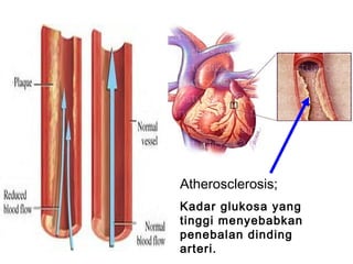 Atherosclerosis;
Kadar glukosa yang
tinggi menyebabkan
penebalan dinding
arteri.
 
