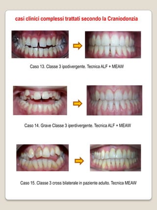 casi clinici complessi trattati secondo la Craniodonzia




       Caso 13. Classe 3 ipodivergente. Tecnica ALF + MEAW




    Caso 14. Grave Classe 3 iperdivergente. Tecnica ALF + MEAW




  Caso 15. Classe 3 cross bilaterale in paziente adulto. Tecnica MEAW
 