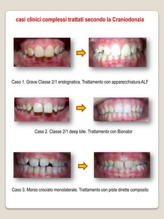 casi clinici complessi trattati secondo la Craniodonzia




Caso 1. Grave Classe 2/1 endognatica. Trattamento con apparecchiatura ALF




            Caso 2. Classe 2/1 deep bite. Trattamento con Bionator




Caso 3. Morso crociato monolaterale. Trattamento con piste dirette composito
 