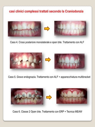 casi clinici complessi trattati secondo la Craniodonzia




 Caso 4. Cross posteriore monolaterale e open bite. Trattamento con ALF




Caso 5. Grave endognazia. Trattamento con ALF + apparecchiatura multibracket




    Caso 6. Classe 2 Open bite. Trattamento con ERP + Tecnica MEAW
 