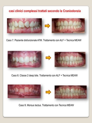 casi clinici complessi trattati secondo la Craniodonzia




Caso 7. Paziente disfunzionale ATM. Trattamento con ALF + Tecnica MEAW




    Caso 8. Classe 2 deep bite. Trattamento con ALF + Tecnica MEAW




           Caso 9. Morsus tectus. Trattamento con Tecnica MEAW
 