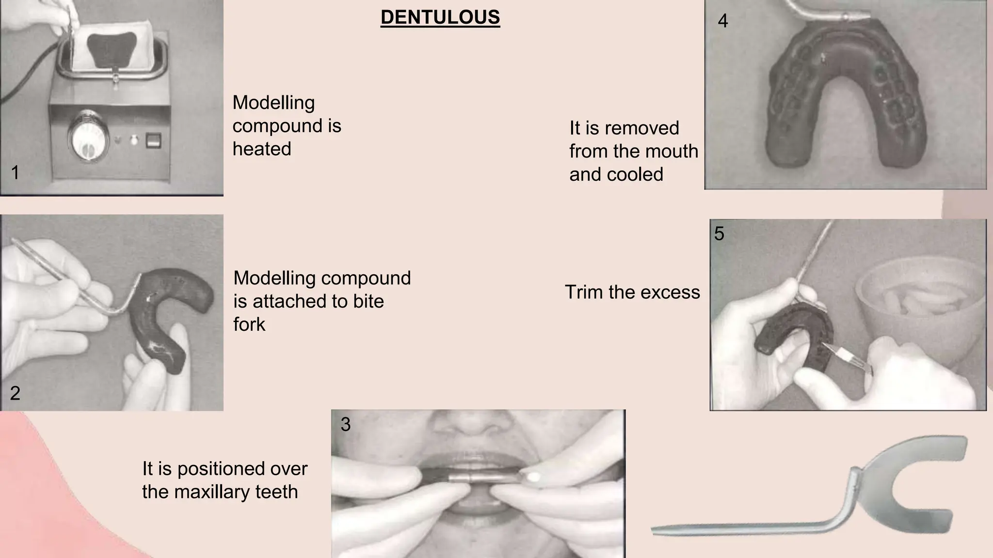 Modelling
compound is
heated
Modelling compound
is attached to bite
fork
It is positioned over
the maxillary teeth
It is removed
from the mouth
and cooled
Trim the excess
1
2
3
4
5
DENTULOUS
 