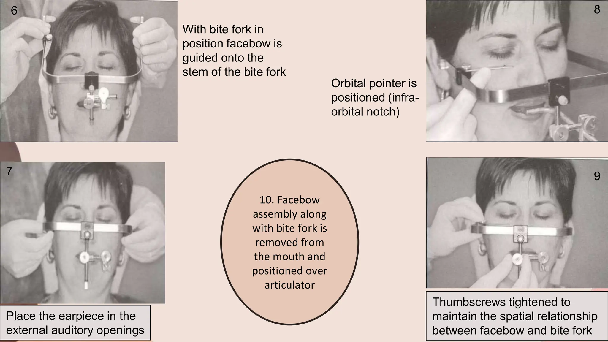 With bite fork in
position facebow is
guided onto the
stem of the bite fork
Place the earpiece in the
external auditory openings
Orbital pointer is
positioned (infra-
orbital notch)
Thumbscrews tightened to
maintain the spatial relationship
between facebow and bite fork
10. Facebow
assembly along
with bite fork is
removed from
the mouth and
positioned over
articulator
6
7 9
8
 