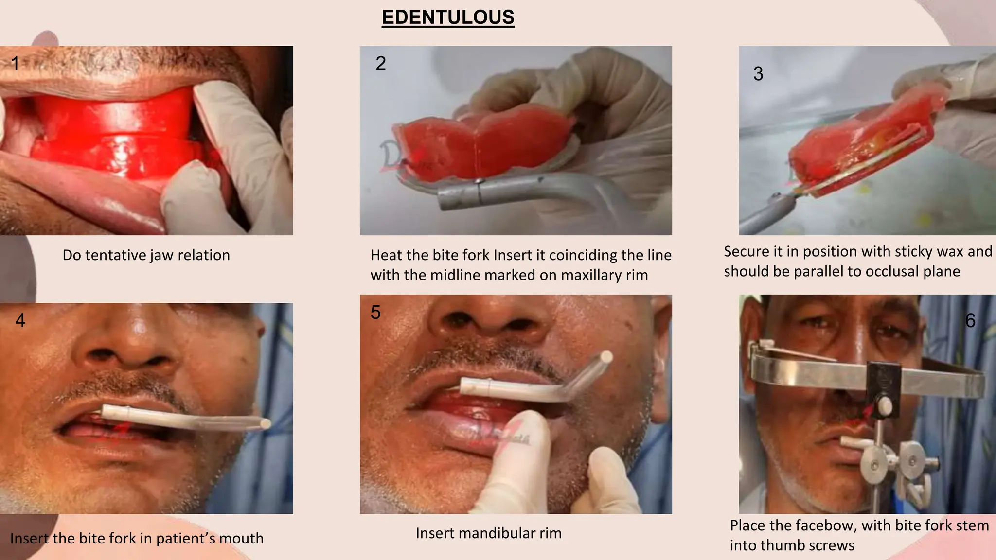 EDENTULOUS
Do tentative jaw relation Heat the bite fork Insert it coinciding the line
with the midline marked on maxillary rim
Secure it in position with sticky wax and
should be parallel to occlusal plane
Insert the bite fork in patient’s mouth Insert mandibular rim Place the facebow, with bite fork stem
into thumb screws
1
3
2
4 6
5
 
