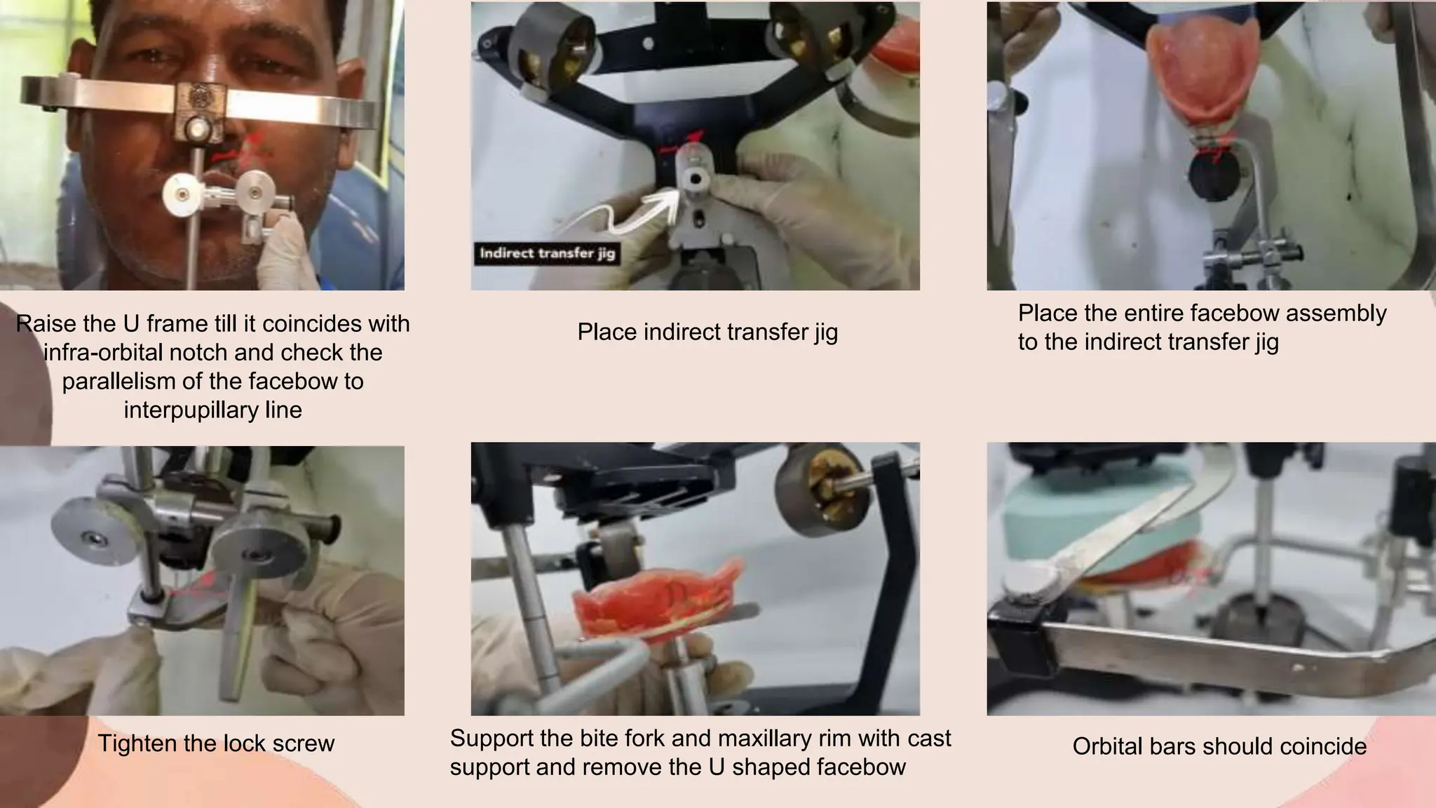 Raise the U frame till it coincides with
infra-orbital notch and check the
parallelism of the facebow to
interpupillary line
Place indirect transfer jig
Place the entire facebow assembly
to the indirect transfer jig
Tighten the lock screw Support the bite fork and maxillary rim with cast
support and remove the U shaped facebow
Orbital bars should coincide
 