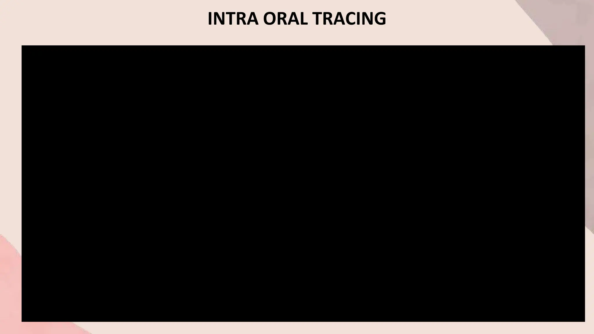 INTRA ORAL TRACING
 