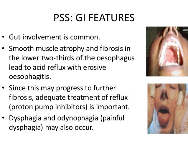 Progresive systemic sclerosis