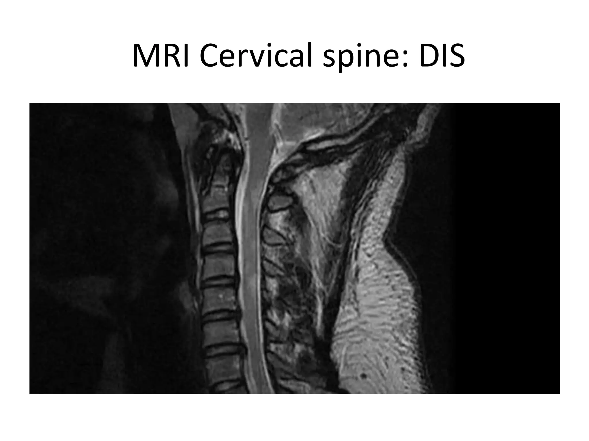 MRI Cervical spine: DIS
 
