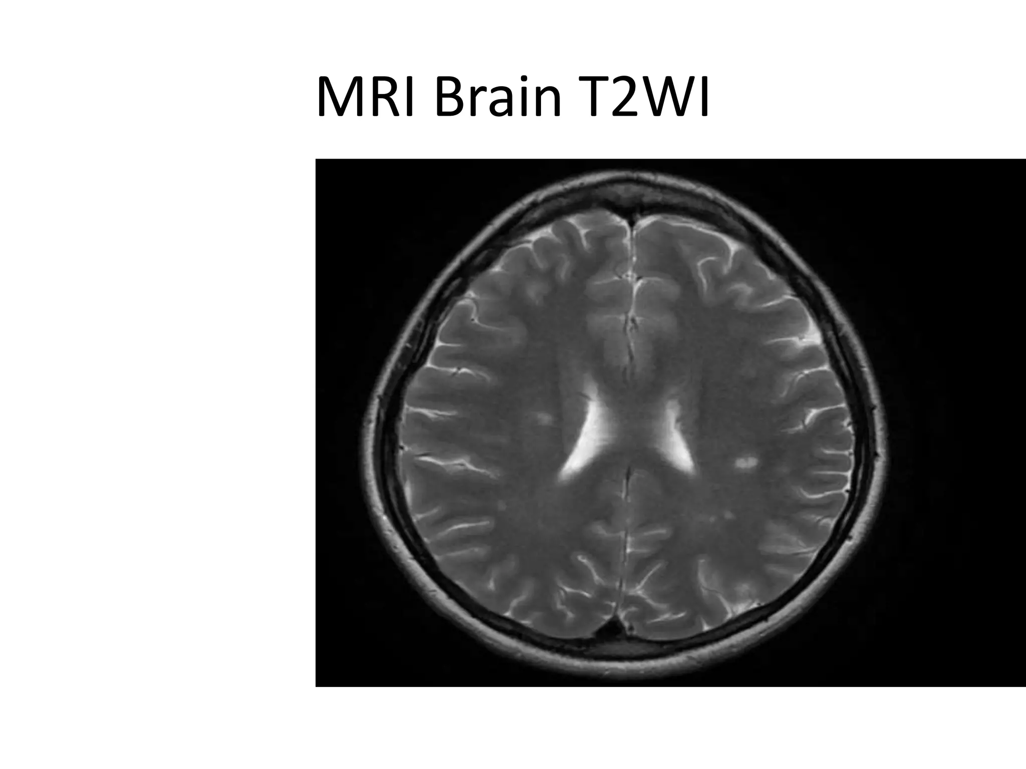 MRI Brain T2WI
 
