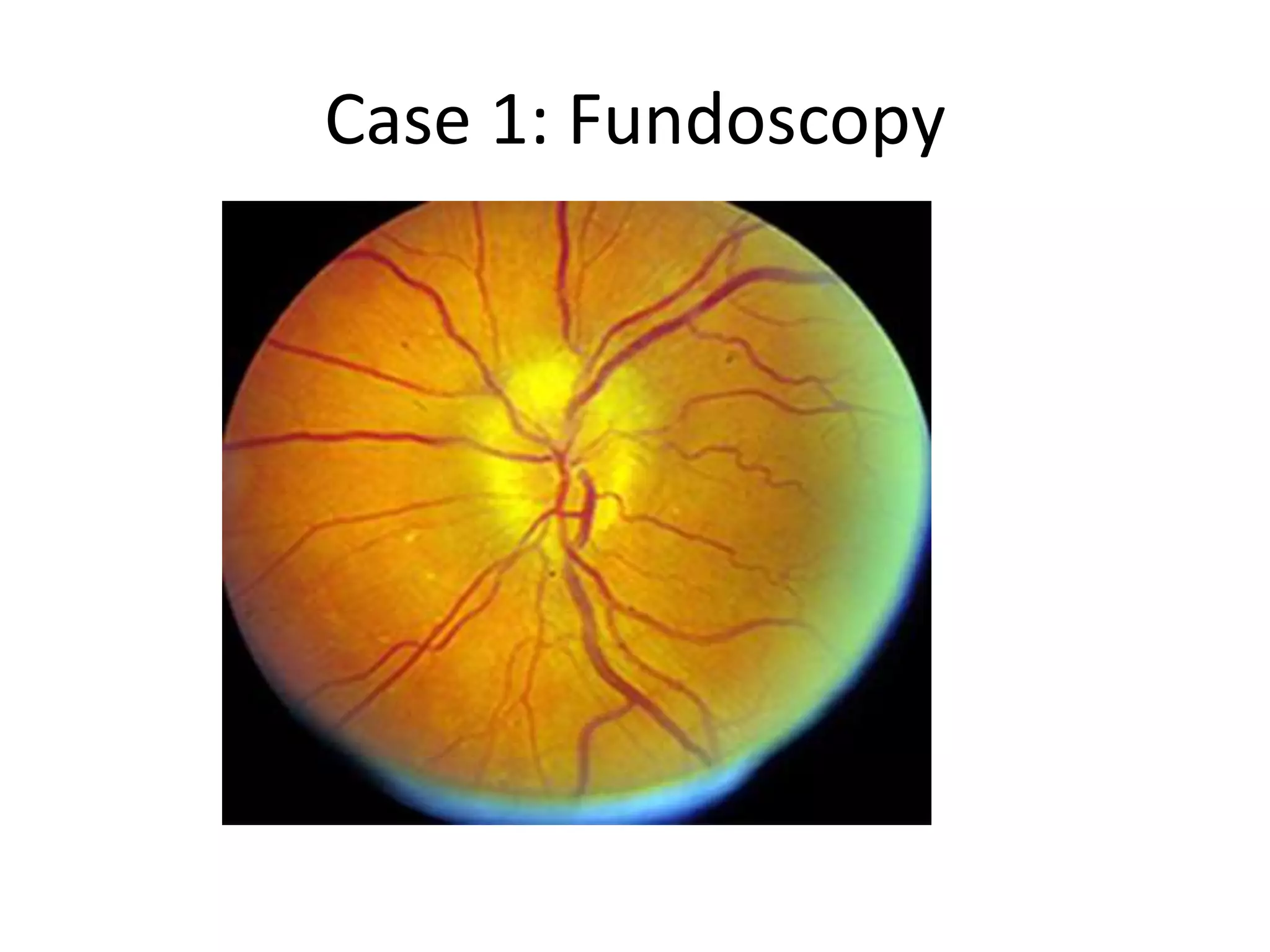 Case 1: Fundoscopy
 