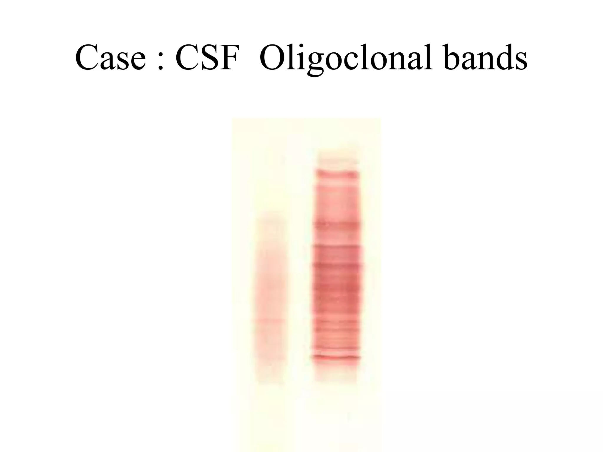 Case : CSF Oligoclonal bands
 