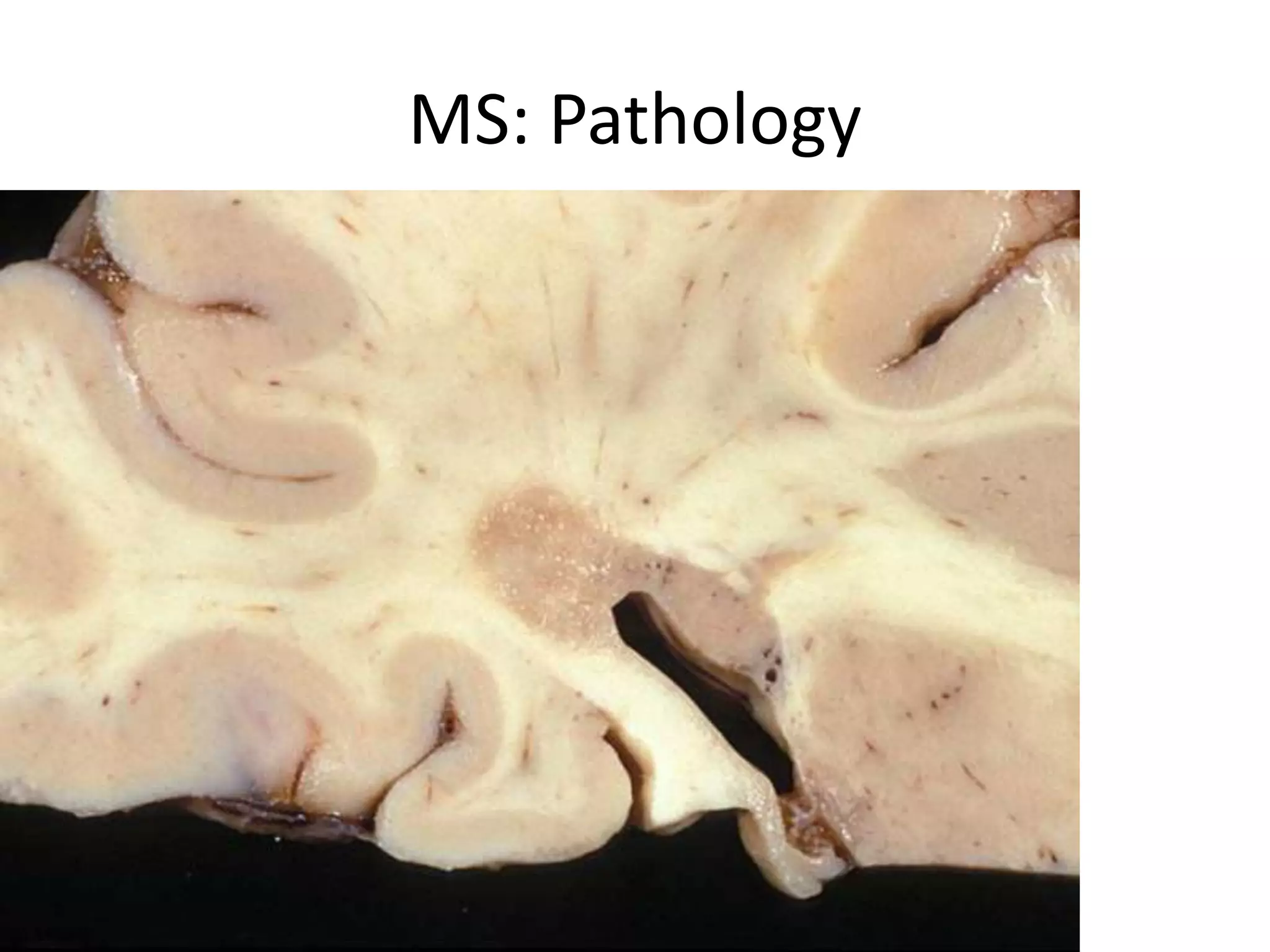 MS: Pathology
 