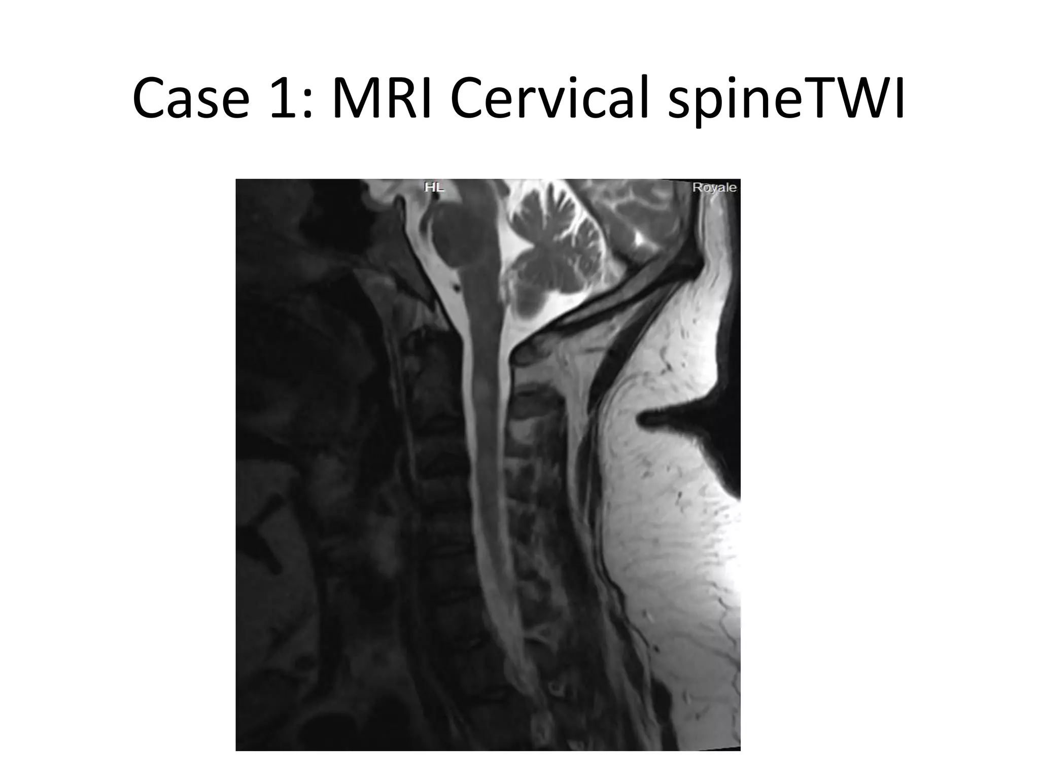 Case 1: MRI Cervical spineTWI
 