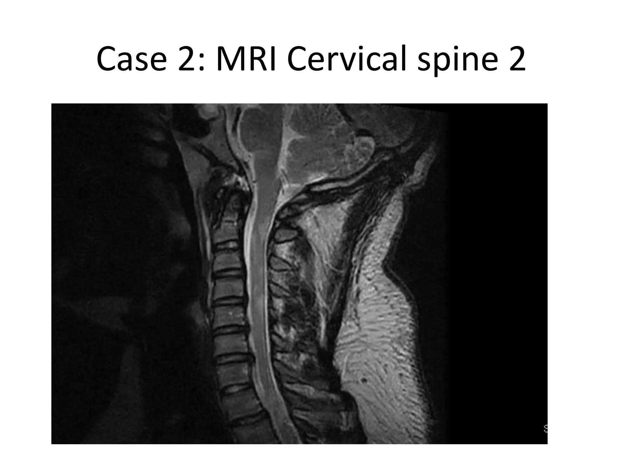 Case 2: MRI Cervical spine 2
 