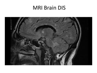 MRI Brain DIS
 