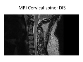 MRI Cervical spine: DIS
 