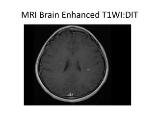 MRI Brain Enhanced T1WI:DIT
 
