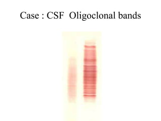 Case : CSF Oligoclonal bands
 