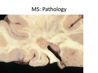 MS: Pathology
 