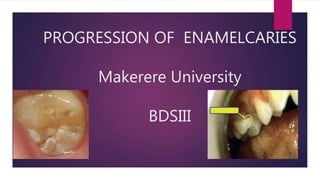 PROGRESSION OF ENAMELCARIES
Makerere University
BDSIII
 