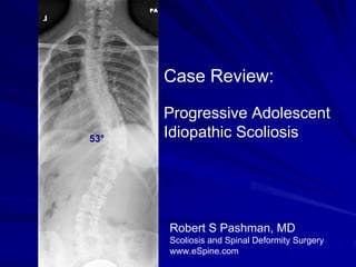 Case Review:

      Progressive Adolescent
53°   Idiopathic Scoliosis




      Robert S Pashman, MD
      Scoliosis and Spinal Deformity Surgery
      www.eSpine.com
 