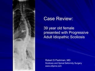 Case Review:
      39 year old female
51°
      presented with Progressive
      Adult Idiopathic Scoliosis




      Robert S Pashman, MD
      Scoliosis and Spinal Deformity Surgery
      www.eSpine.com
 