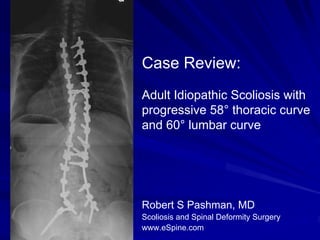 Case Review:
Adult Idiopathic Scoliosis with
progressive 58° thoracic curve
and 60° lumbar curve




Robert S Pashman, MD
Scoliosis and Spinal Deformity Surgery
www.eSpine.com
 