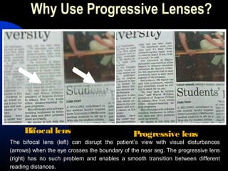 Why Use Progressive Lenses?
Bifocal lens Progressive lens
The bifocal lens (left) can disrupt the patient’s view with visual disturbances
(arrows) when the eye crosses the boundary of the near seg. The progressive lens
(right) has no such problem and enables a smooth transition between different
reading distances.
 
